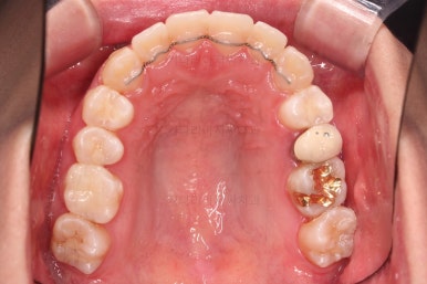 부산비대칭교정