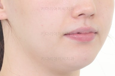 부산비대칭교정