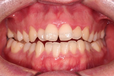 부산긴얼굴긴턱교정