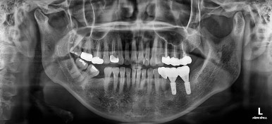 연산동부분교정