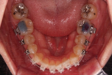 부산치아교정잘하는곳