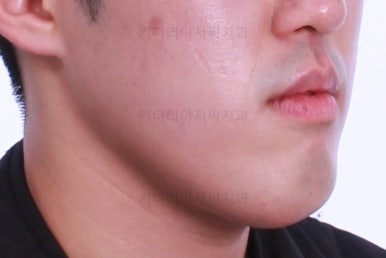부산긴얼굴긴턱교정