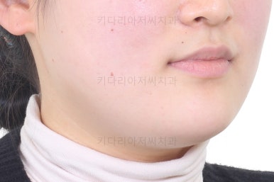 부산치아교정
