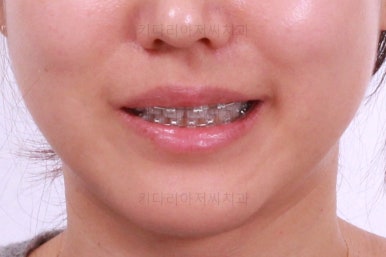 부산치아교정잘하는곳
