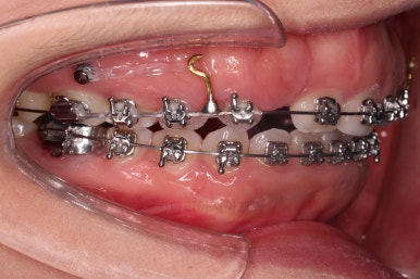 부산구순구개열