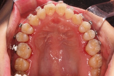 부산비발치교정