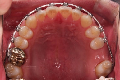 연산동임플란트