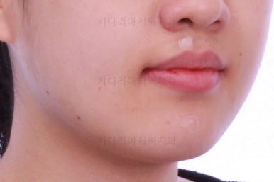 부산비발치교정