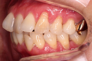 동래임플란트교정