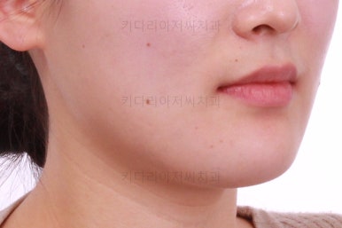 부산치아교정