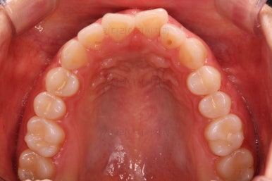 부산나비앞니교정
