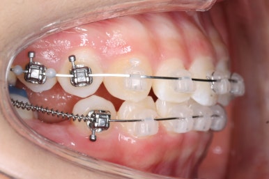 부산치아교정잘하는곳