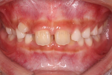 부산어린이돌출입교정