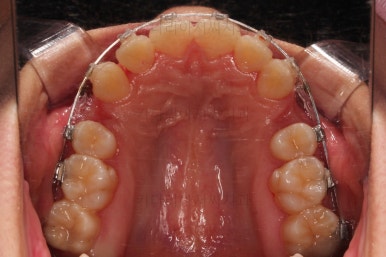 부산클리피씨교정
