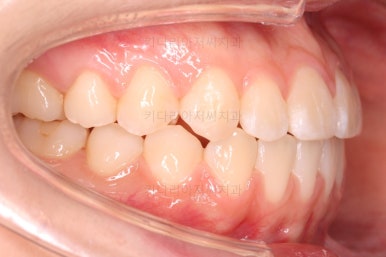 부산치아교정잘하는곳