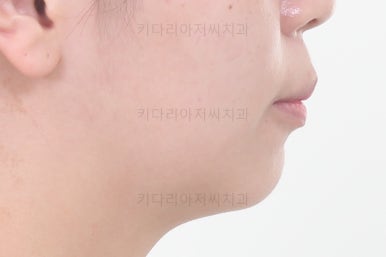 부산사랑니교정