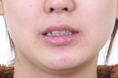 부산안면비대칭