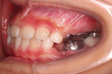 부산어린이반대교합