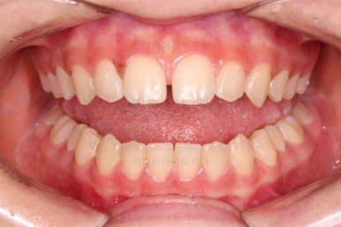 부산앞니벌어짐교정