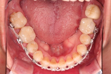 부산구순구개열교정