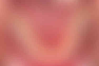 부산구순구개열교정