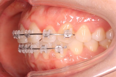 부산나비앞니교정