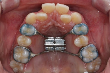 부산비발치교정