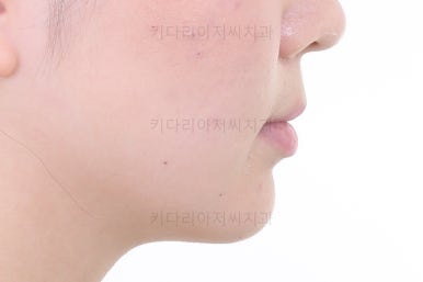 부산치아교정잘하는곳