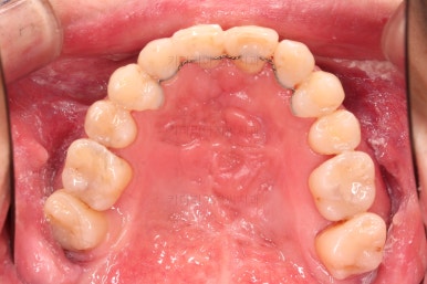 부산구순구개열교정