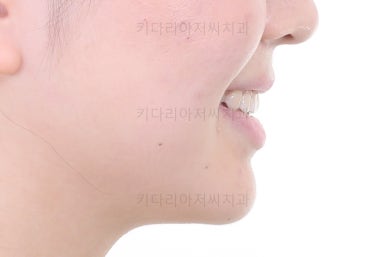 부산치아교정잘하는곳