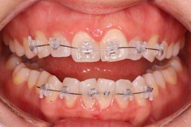 부산나비앞니교정