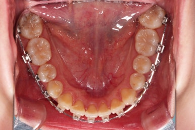 부산치아교정추천