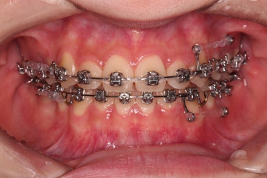 동래구치아교정