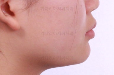 부산어린이치아교정