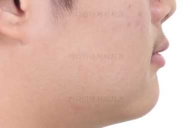 부산성장기교정
