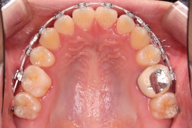 동래구치아교정