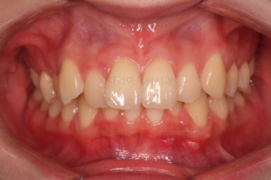 부산돌출입교정