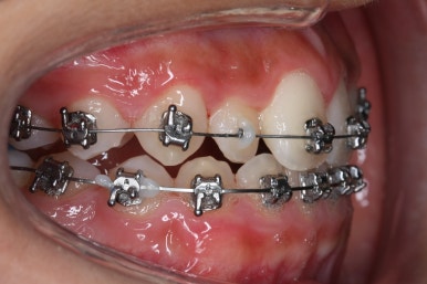 부산비발치교정