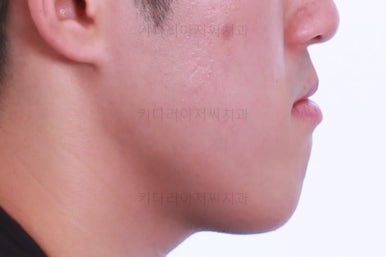 부산긴얼굴긴턱교정