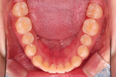 부산앞니벌어짐교정