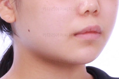 부산앞니벌어짐교정