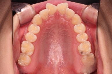 부산앞니부분교정