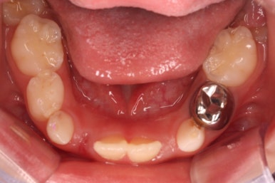 부산어린이치아교정