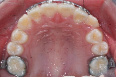 연산동덧니교정