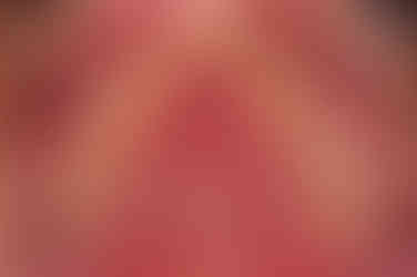 부산구순구개열교정