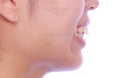 부산연산역치아교정