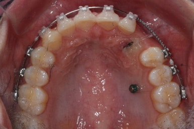 부산매복치아교정