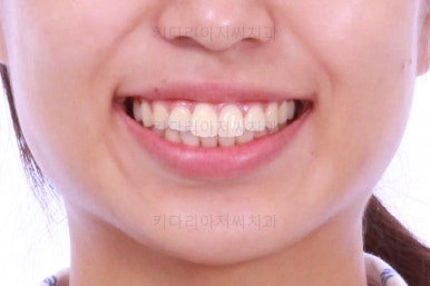 부산연산역치아교정