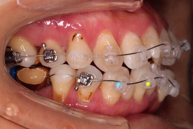 동래임플란트교정