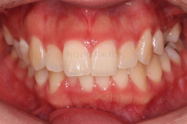 부산비대칭교정